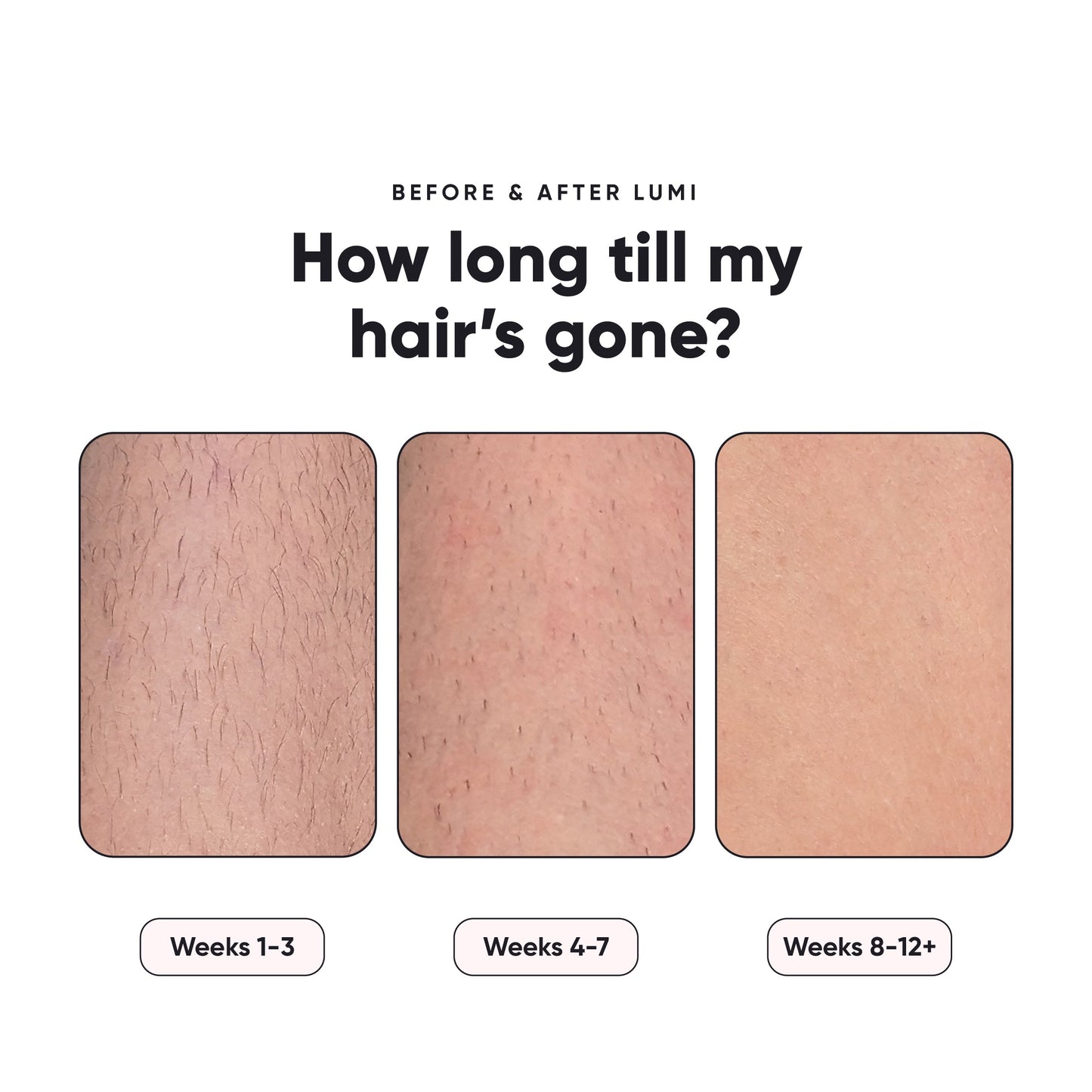 Lumi™ - Permanent Hair Removal Device