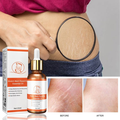 EEHO™ - Stretch Mark Reparing Essential Oil